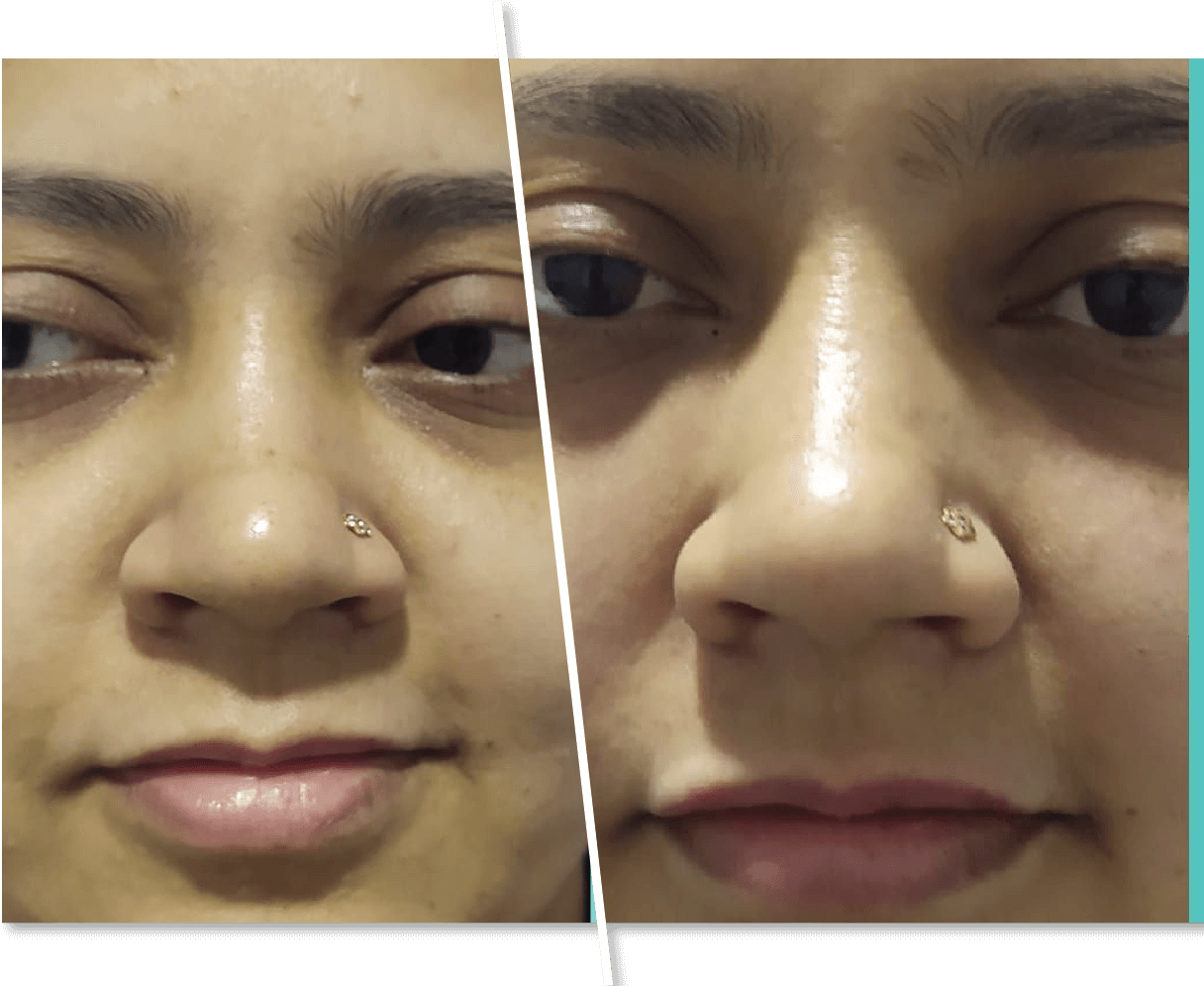 Dark Spot Removal Before and After